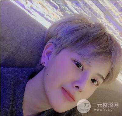 哈醫(yī)大二院整形科肖志波割雙眼皮對(duì)比圖男性案例