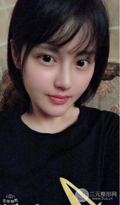 常州施爾美廉鋒自體脂肪豐臉對(duì)照?qǐng)D案例心情日扎