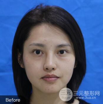 常州施爾美廉鋒自體脂肪豐臉對(duì)照?qǐng)D案例心情日扎