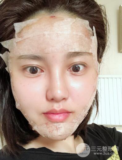 常州施爾美廉鋒自體脂肪豐臉對(duì)照?qǐng)D案例心情日扎