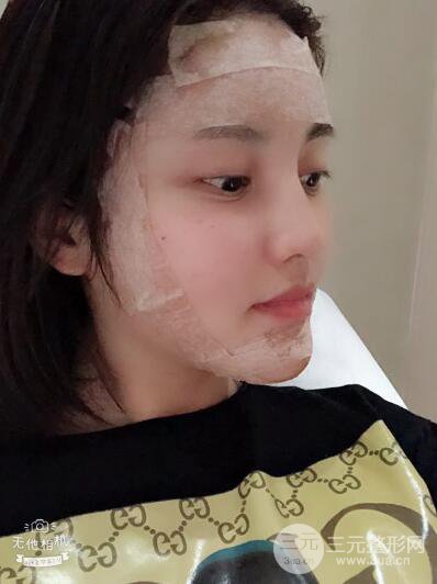 常州施爾美廉鋒自體脂肪豐臉對(duì)照?qǐng)D案例心情日扎