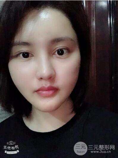 常州施爾美廉鋒自體脂肪豐臉對(duì)照?qǐng)D案例心情日扎