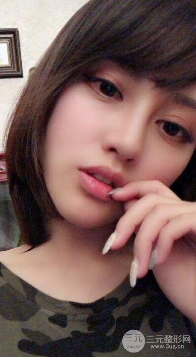 常州施爾美廉鋒自體脂肪豐臉對(duì)照?qǐng)D案例心情日扎