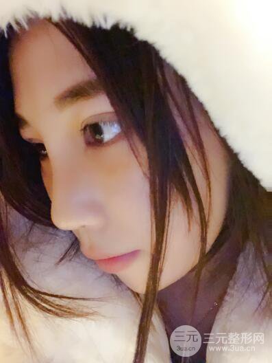 貴陽麗都李觀龍隆鼻整形案例對照圖一個月恢復(fù)過程分享