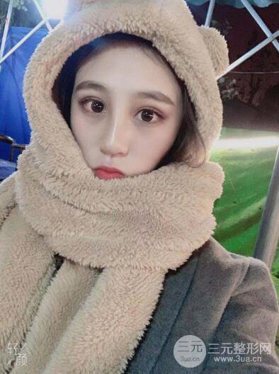 貴陽麗都李觀龍隆鼻整形案例對照圖一個月恢復(fù)過程分享