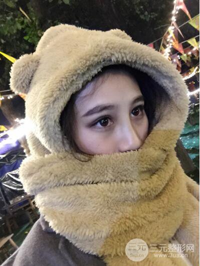 貴陽麗都李觀龍隆鼻整形案例對照圖一個月恢復(fù)過程分享