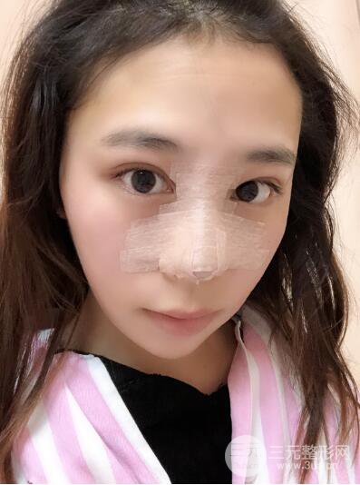貴陽麗都李觀龍隆鼻整形案例對照圖一個月恢復(fù)過程分享