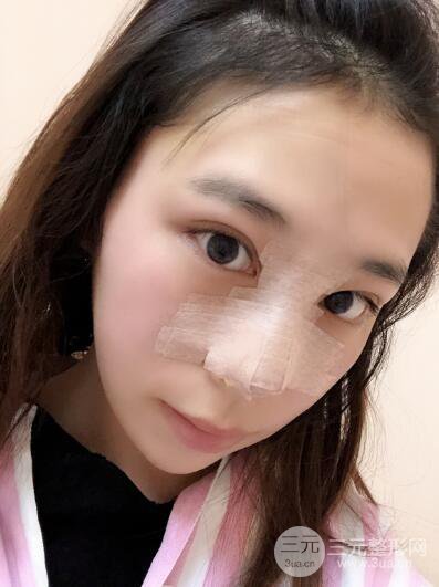 貴陽麗都李觀龍隆鼻整形案例對照圖一個月恢復(fù)過程分享