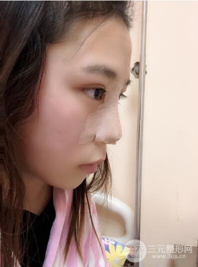 貴陽麗都李觀龍隆鼻整形案例對照圖一個月恢復(fù)過程分享