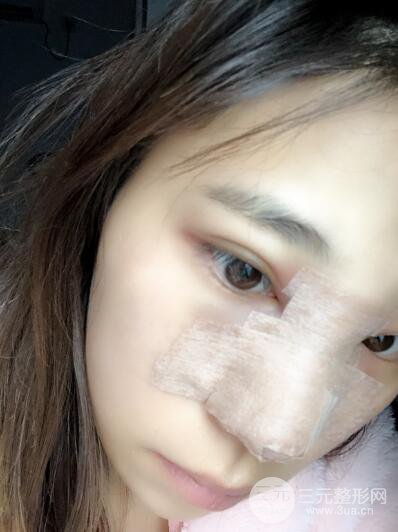 貴陽麗都李觀龍隆鼻整形案例對照圖一個月恢復(fù)過程分享