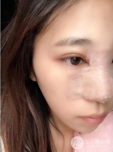 貴陽麗都李觀龍隆鼻整形案例對照圖一個月恢復(fù)過程分享