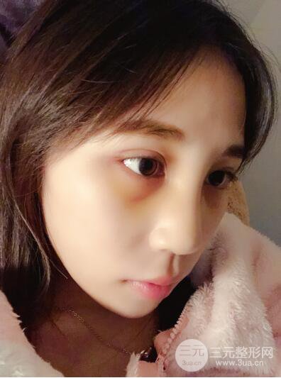 貴陽麗都李觀龍隆鼻整形案例對照圖一個月恢復(fù)過程分享