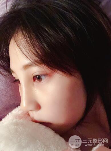 貴陽麗都李觀龍隆鼻整形案例對照圖一個月恢復(fù)過程分享