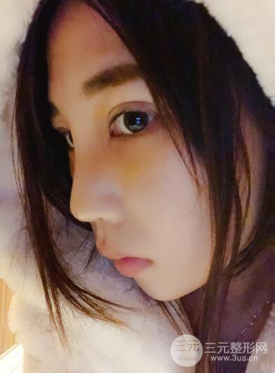 貴陽麗都李觀龍隆鼻整形案例對照圖一個月恢復(fù)過程分享
