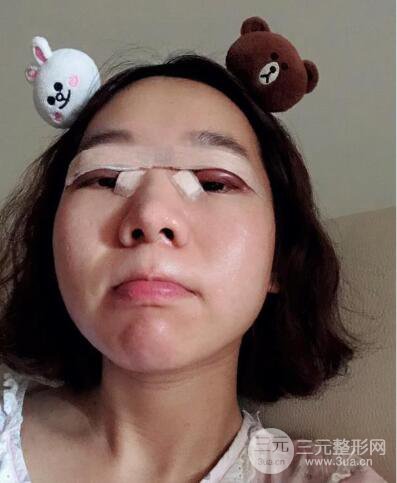 湘潭華美切開(kāi)雙眼皮案例對(duì)照?qǐng)D兩個(gè)月恢復(fù)過(guò)程心情日扎