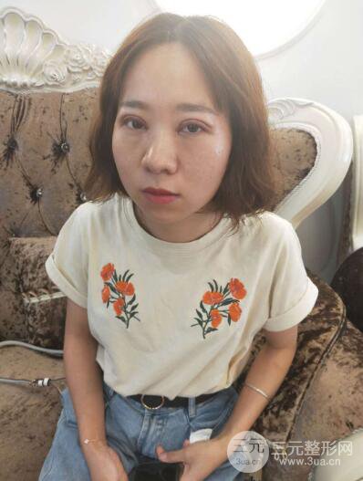 湘潭華美切開(kāi)雙眼皮案例對(duì)照?qǐng)D兩個(gè)月恢復(fù)過(guò)程心情日扎
