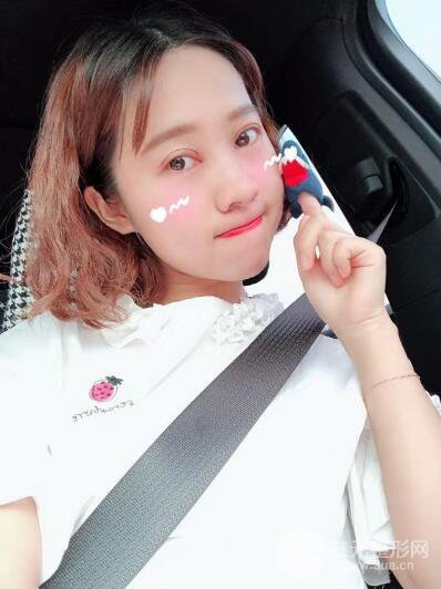 湘潭華美切開(kāi)雙眼皮案例對(duì)照?qǐng)D兩個(gè)月恢復(fù)過(guò)程心情日扎