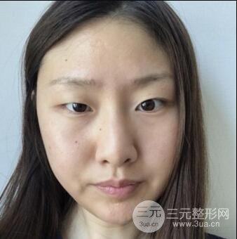 西安葉子魯禮新埋線雙眼皮案例對照圖!兩個月恢復(fù)心情小記