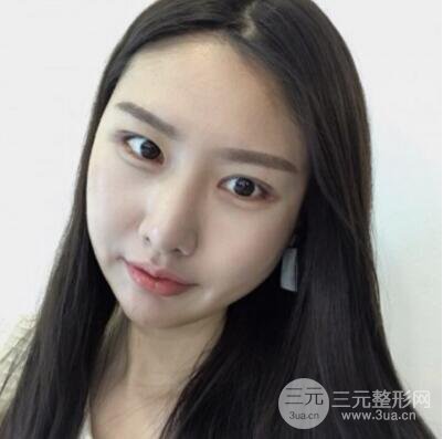 西安葉子魯禮新埋線雙眼皮案例對照圖!兩個月恢復(fù)心情小記
