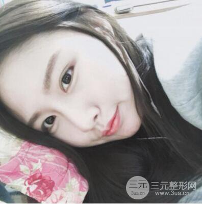 西安葉子魯禮新埋線雙眼皮案例對照圖!兩個月恢復(fù)心情小記