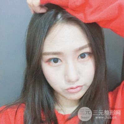 西安葉子魯禮新埋線雙眼皮案例對照圖!兩個月恢復(fù)心情小記