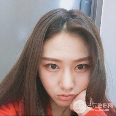 西安葉子魯禮新埋線雙眼皮案例對照圖!兩個月恢復(fù)心情小記