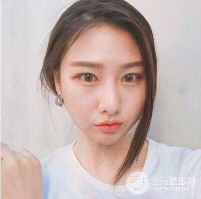 西安葉子魯禮新埋線雙眼皮案例對照圖!兩個月恢復(fù)心情小記