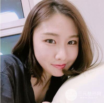 西安葉子魯禮新埋線雙眼皮案例對照圖!兩個月恢復(fù)心情小記