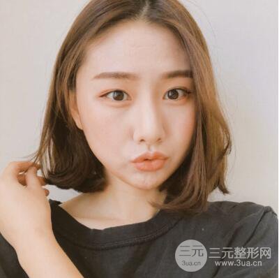 西安葉子魯禮新埋線雙眼皮案例對照圖!兩個月恢復(fù)心情小記