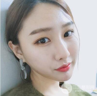 西安葉子魯禮新埋線雙眼皮案例對照圖!兩個月恢復(fù)心情小記