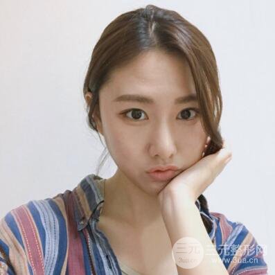 西安葉子魯禮新埋線雙眼皮案例對照圖!兩個月恢復(fù)心情小記