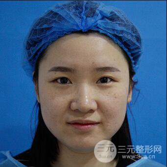 貴陽美萊梁潔芭比媚雙眼皮多項整形前后對比圖恢復(fù)心情小札