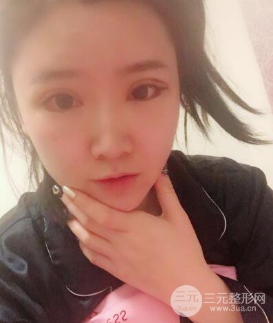 貴陽美萊梁潔芭比媚雙眼皮多項整形前后對比圖恢復(fù)心情小札