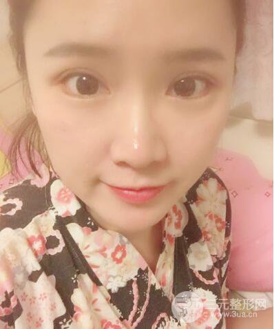 貴陽美萊梁潔芭比媚雙眼皮多項整形前后對比圖恢復(fù)心情小札