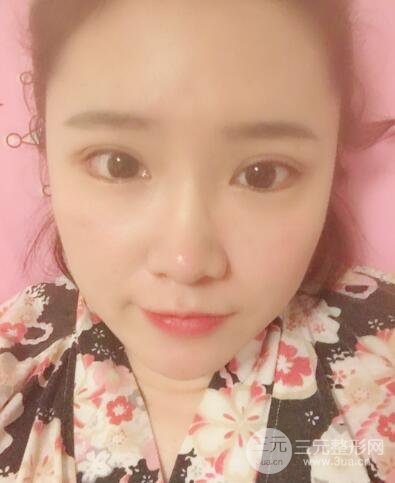 貴陽美萊梁潔芭比媚雙眼皮多項整形前后對比圖恢復(fù)心情小札