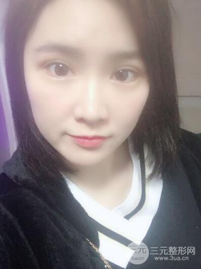 貴陽美萊梁潔芭比媚雙眼皮多項整形前后對比圖恢復(fù)心情小札