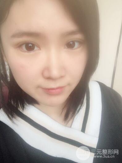 貴陽美萊梁潔芭比媚雙眼皮多項整形前后對比圖恢復(fù)心情小札