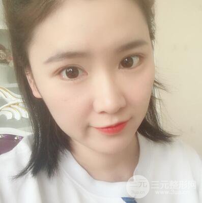 貴陽美萊梁潔芭比媚雙眼皮多項整形前后對比圖恢復(fù)心情小札