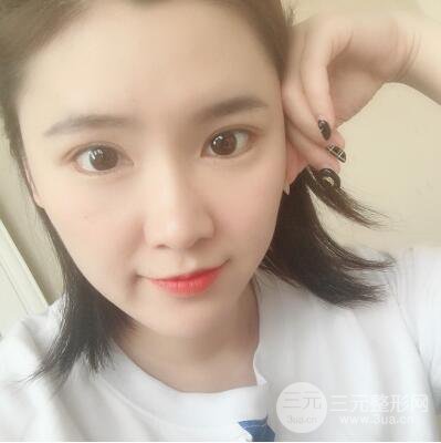 貴陽美萊梁潔芭比媚雙眼皮多項整形前后對比圖恢復(fù)心情小札