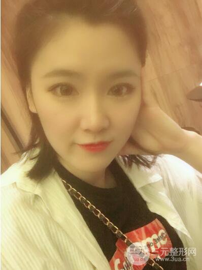 貴陽美萊梁潔芭比媚雙眼皮多項整形前后對比圖恢復(fù)心情小札