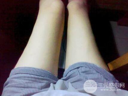 注射注射瘦腿反彈會(huì)更粗嗎