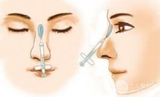 玻尿酸能打鼻尖么？果是否持久、術(shù)后怎樣護(hù)理