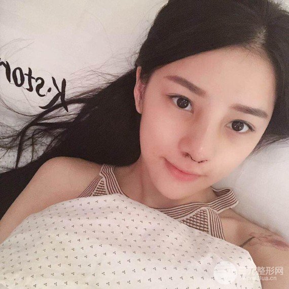 【隆鼻整形+進(jìn)口假體+耳軟骨墊鼻尖+鼻頭鼻翼縮小+鼻尖延長】綜合改良！