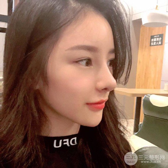 【隆鼻整形+進(jìn)口假體+耳軟骨墊鼻尖+鼻頭鼻翼縮小+鼻尖延長】綜合改良！