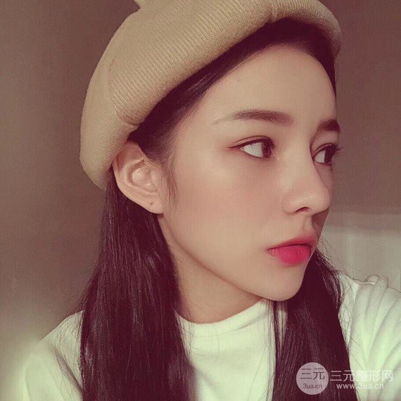 【隆鼻整形+進(jìn)口假體+耳軟骨墊鼻尖+鼻頭鼻翼縮小+鼻尖延長】綜合改良！