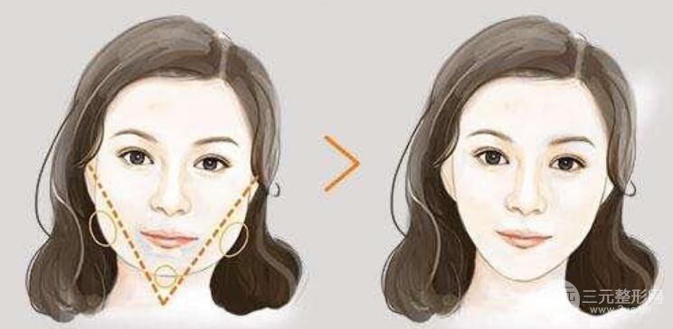 下頜角切除費用要多少？怎么護理？