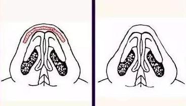 膨體材料隆鼻需要多少錢？價格影響有哪些？