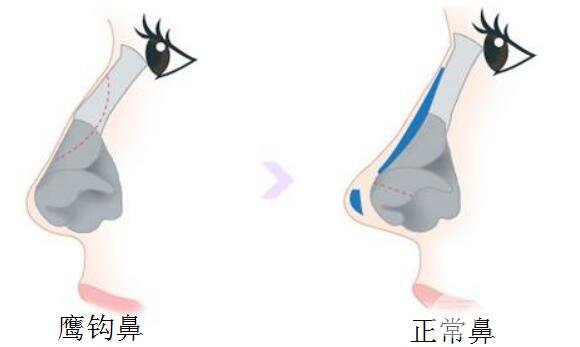 鷹鉤鼻矯正方法有什么？手術過程是怎樣的？