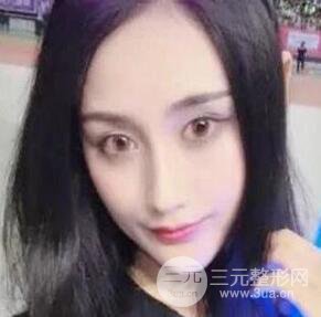 北京伊美爾何禎平做完雙眼皮