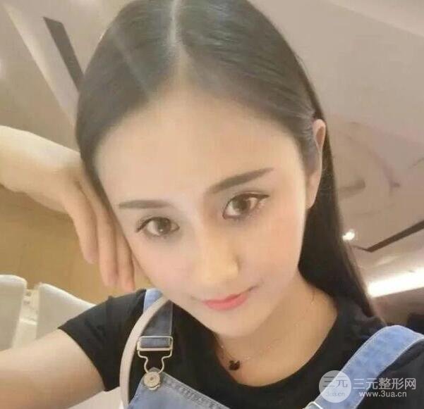 北京伊美爾何禎平做完雙眼皮